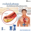 ทำความรู้จักกับภาวะไขมันในเลือดสูงและวิธีการป้องกัน